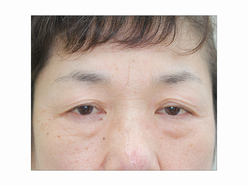 三白眼からの四白眼、黒目を大きくする手術の話