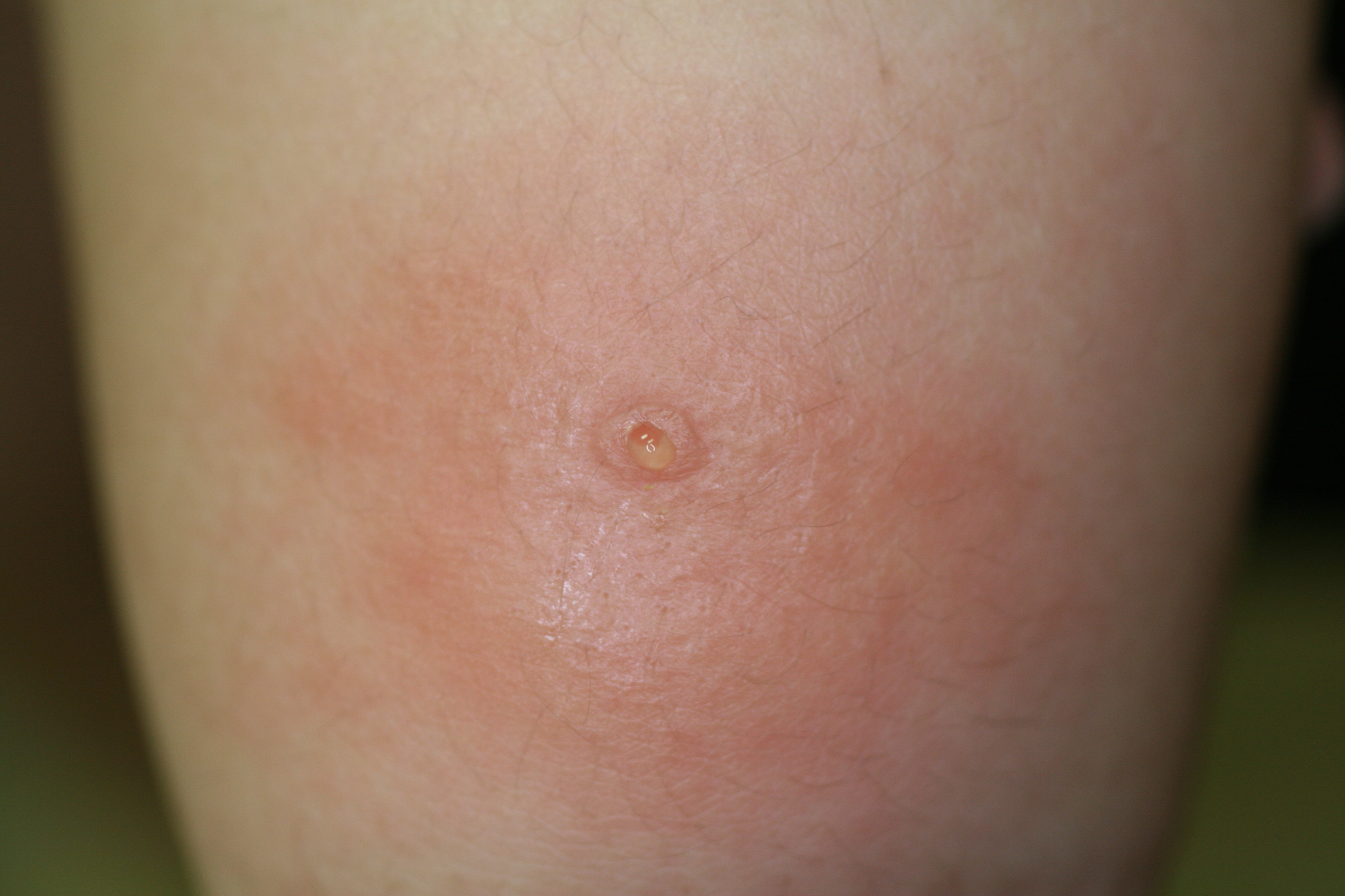 虫 毒虫の種類と刺された時の症状・対処法虫さされ情報館池田模範堂