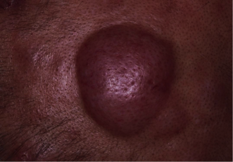 扁桃がん、扁桃の悪性リンパ腫、中咽頭がんについて・笠井耳鼻咽喉科クリニック