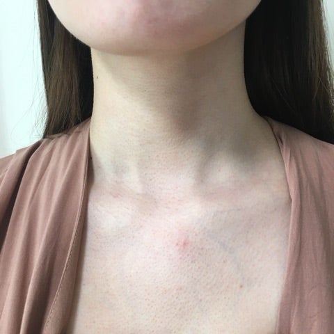 デコルテのかゆみとストレスの関係—東洋医学的アプローチで根本改善へ川崎市多摩区のアトピー専門整体「英気治療院」