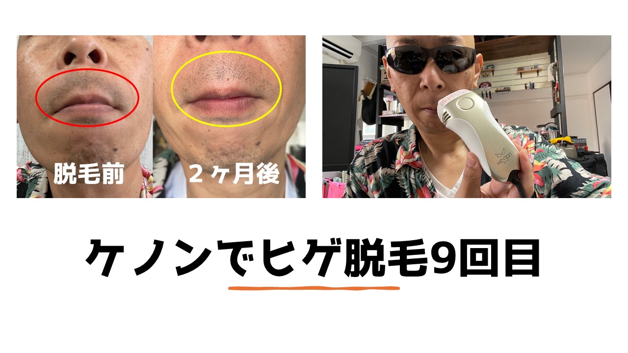 体験談 湘南美容クリニックヒゲ脱毛6回は効果ない？ツルツルになる？ - とものヒゲ脱毛ブログ