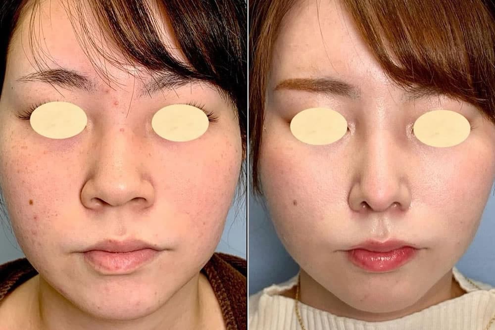 鼻翼縮小をすると不自然な鼻になることがある？ドクターブログ鼻の整形なら東京イセアクリニック