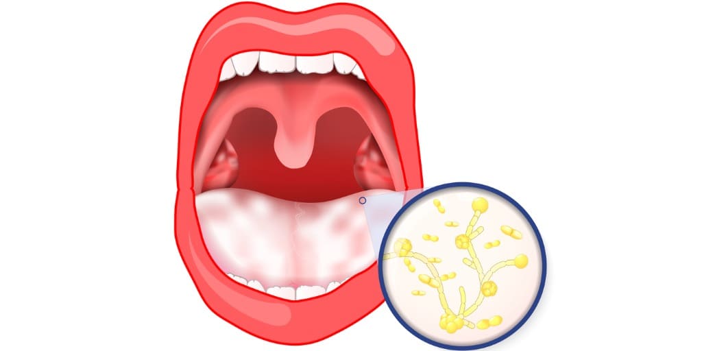 ニコチン性口内炎とは - 医療総合QLife