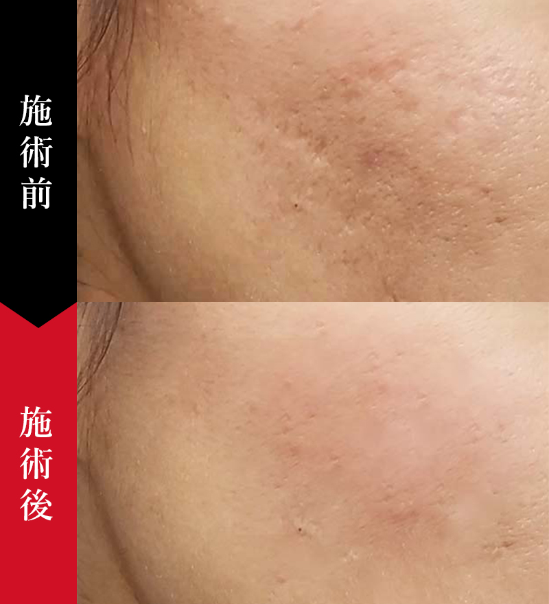 田中みな実も愛用！セルフダーマペン！エンビロンで肌質変わります