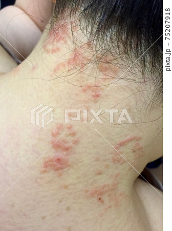 アトピー性皮膚炎：幼児顔面の病変 症例写真 の説明スライド - 医療のイラスト・写真・動画、素材販売サイトのメディック medick