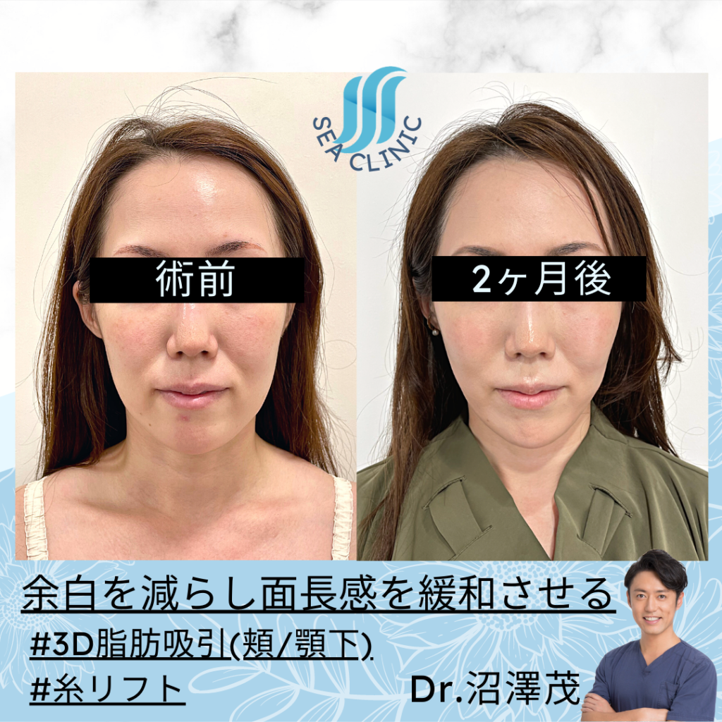 小顔複合施術 で下膨れ顔を解消！理想の小顔を手に入れる！症例写真・ビフォーアフター美容整形・美容外科のTAクリニックグループ