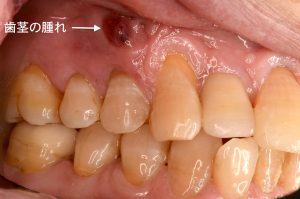 奥歯が腫れている どこが痛いかわからない 根管治療