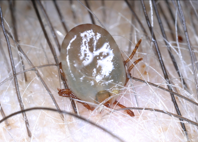 マダニ咬傷 - 22. 外傷と中毒 - MSDマニュアル プロフェッショナル版