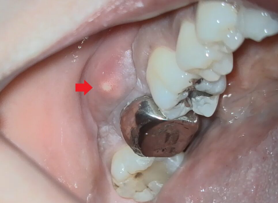 歯茎の腫れと深い歯周ポケット 原因は歯の内部の感染だった歯内療法 根管治療 ウィキペディア