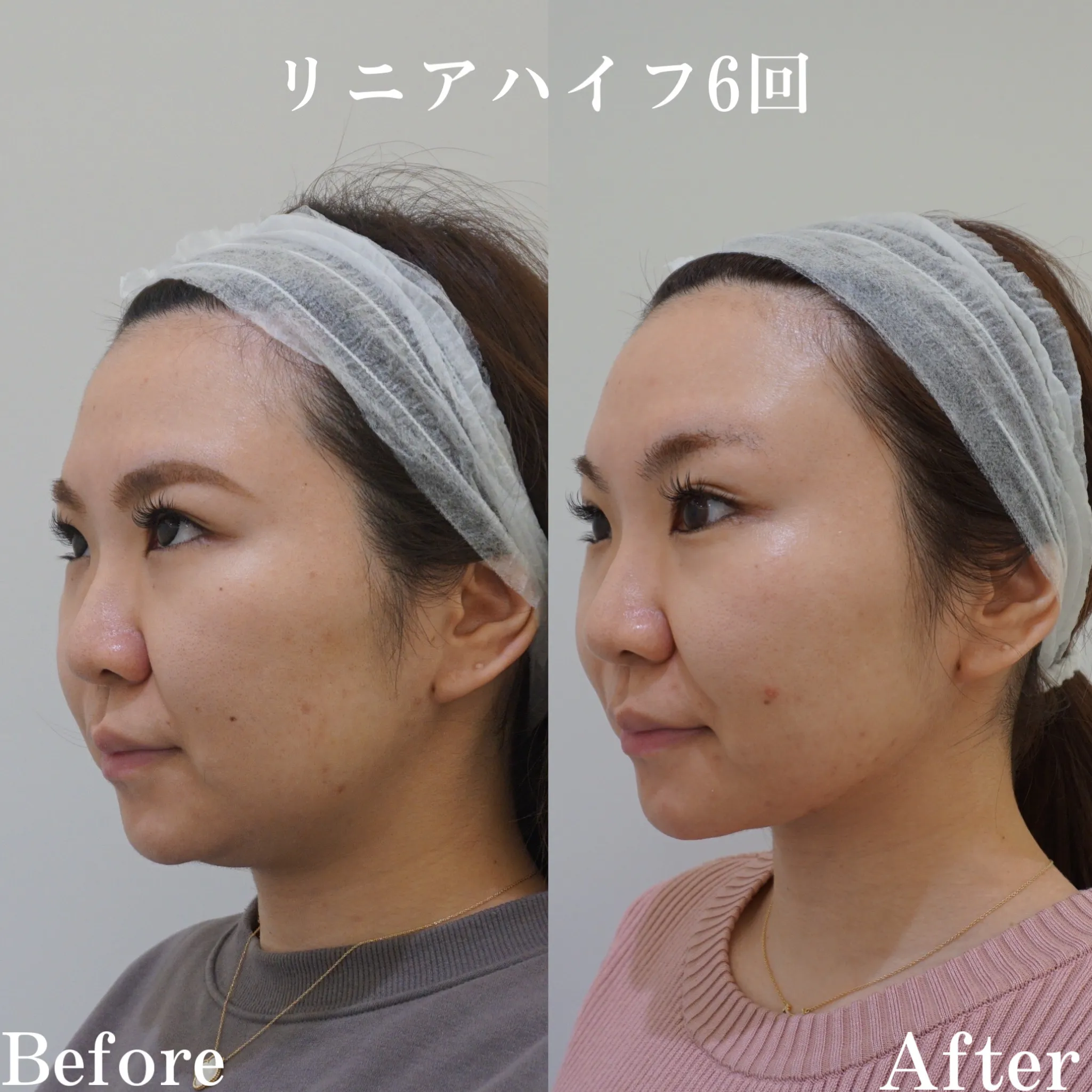 顔の余白を減らして垢抜け美人に！ - WOMクリニック銀座