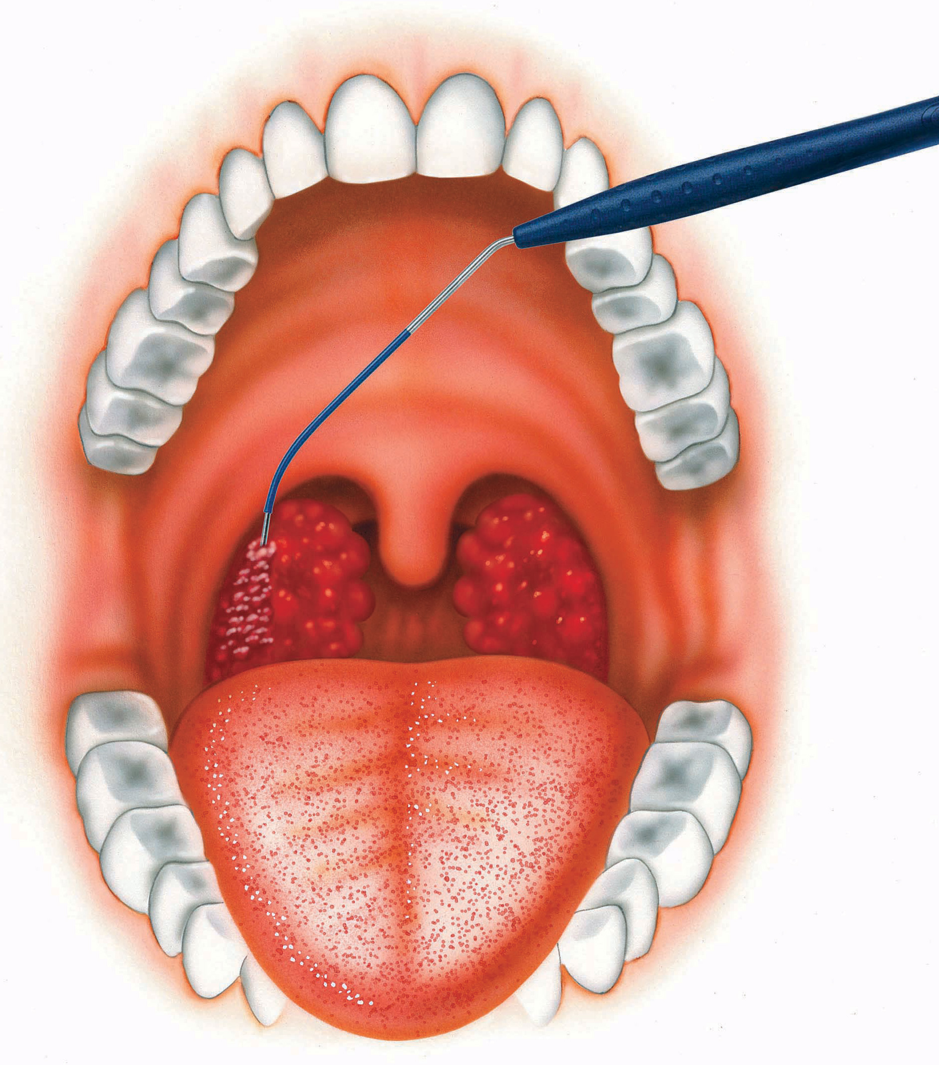 慢性扁桃炎と扁桃肥大・笠井耳鼻咽喉科クリニック