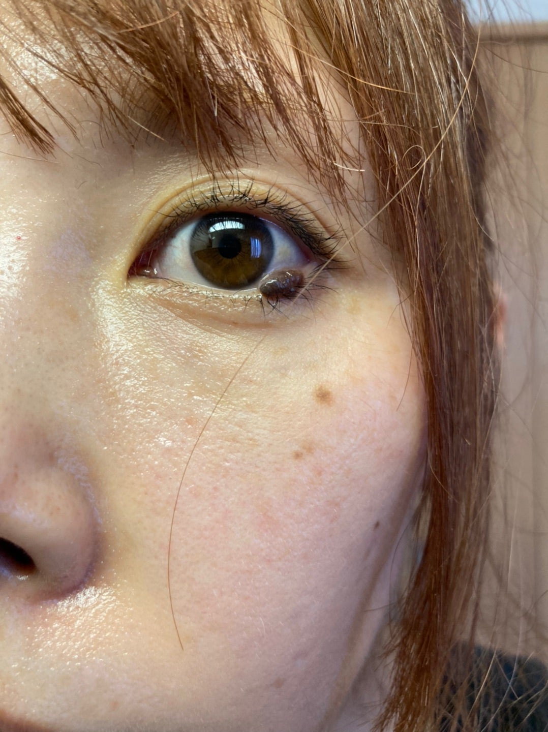 目の周りのほくろ除去 目の上・目の下 大山皮膚科足立区 五反野駅1分の皮膚科