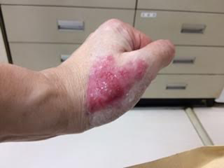 傷・やけどの湿潤治療つかもと内科