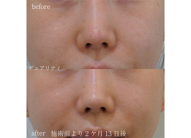 黒ニキビには美容皮膚科の治療ニキビ治療・ニキビ跡治療の東京イセアクリニック