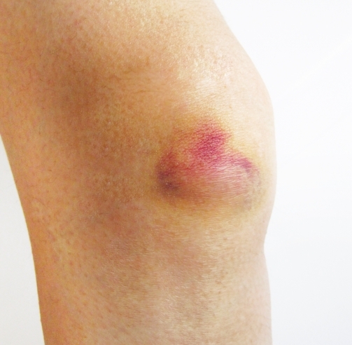 ももかん 太もも打撲からの回復方法その他治療ブログ市位整骨院・鍼灸院、TONEBODY