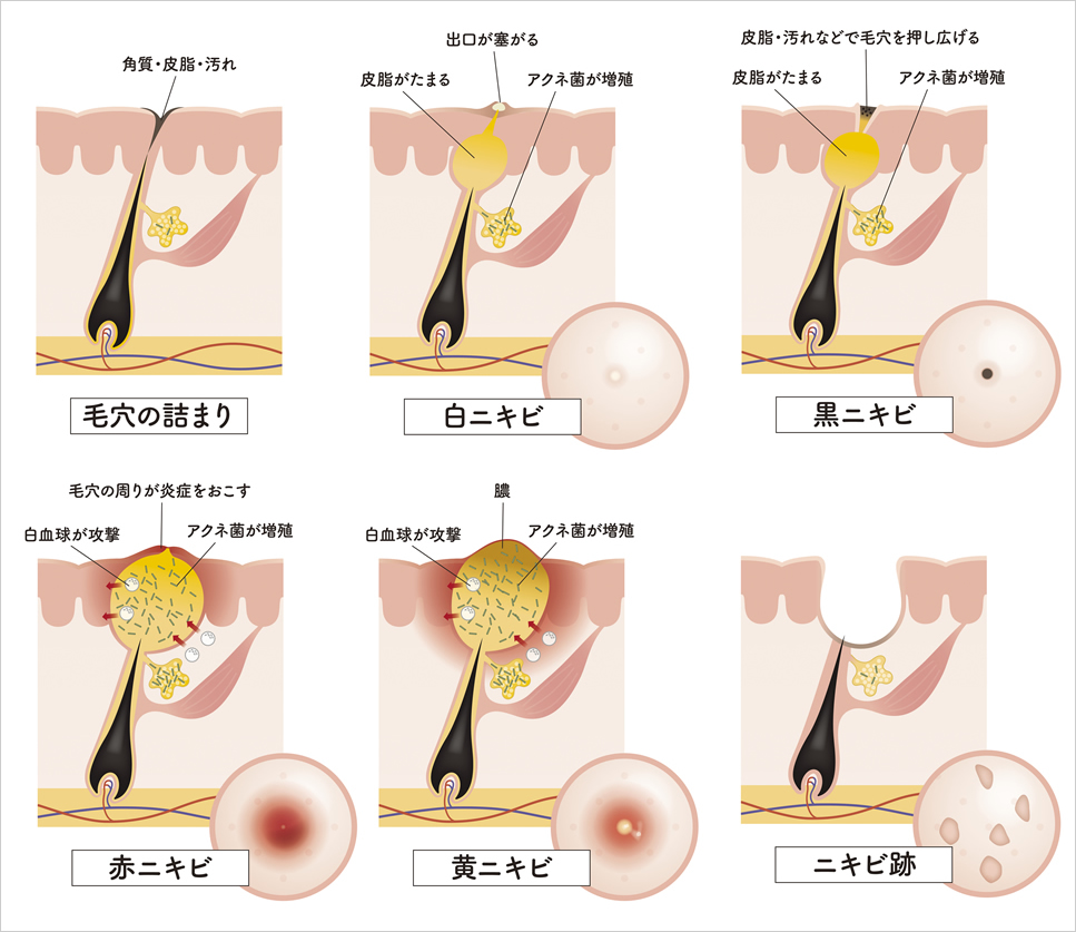 ニキビの芯」の正体は何？埋まっている固い芯の正しいケア方法を知ろうハダメディア by BIHADADO.TOKYO