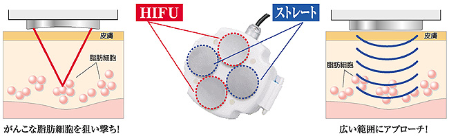 切らない脂肪吸引「キャビテーション」とは？ハイパーナイフとの違いを美容外科医が解説公式コラム美容整形・二重整形なら共立美容外科