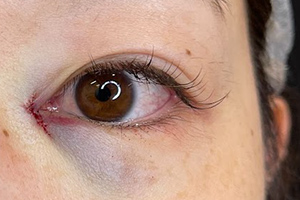 目をぶつけて、まぶたが腫れて内出血している赤ちゃん 2歳3か月、女の子、日本人 の写真素材95183607- PIXTA