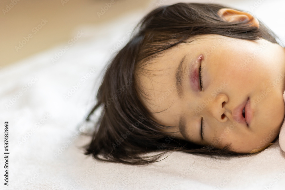 まぶたの内出血について 治るか不安です。目・二重整形 二重埋没法 の治療への不安 痛み・失敗・副作用