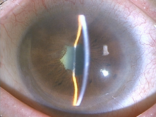 ぶどう膜炎古川中央眼科