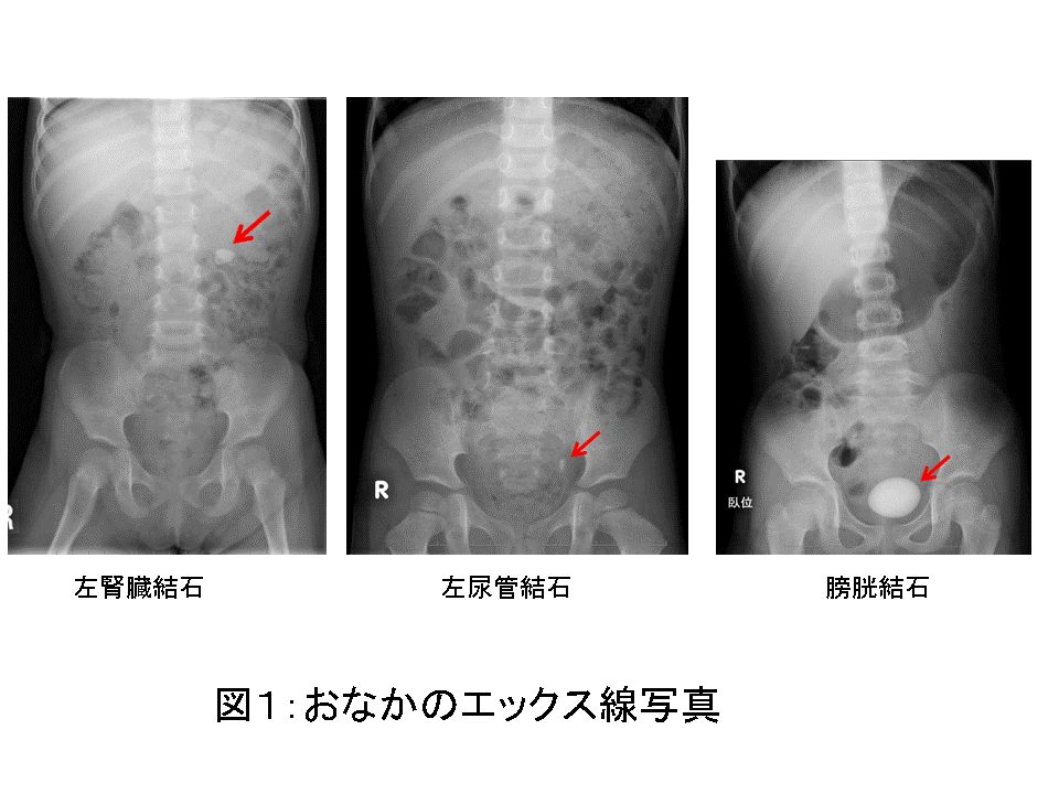 尿管結石を排出させる薬は効く？α遮断薬の研究55件のまとめMEDLEYニュース