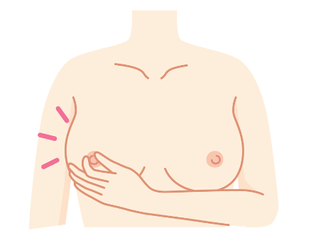 乳がんの初期症状とは？「しこり」のない乳がんもある！?セルフチェックと検診で早期発見を 医師監修乳がん専門の情報メディア乳がんラボ 医師監修