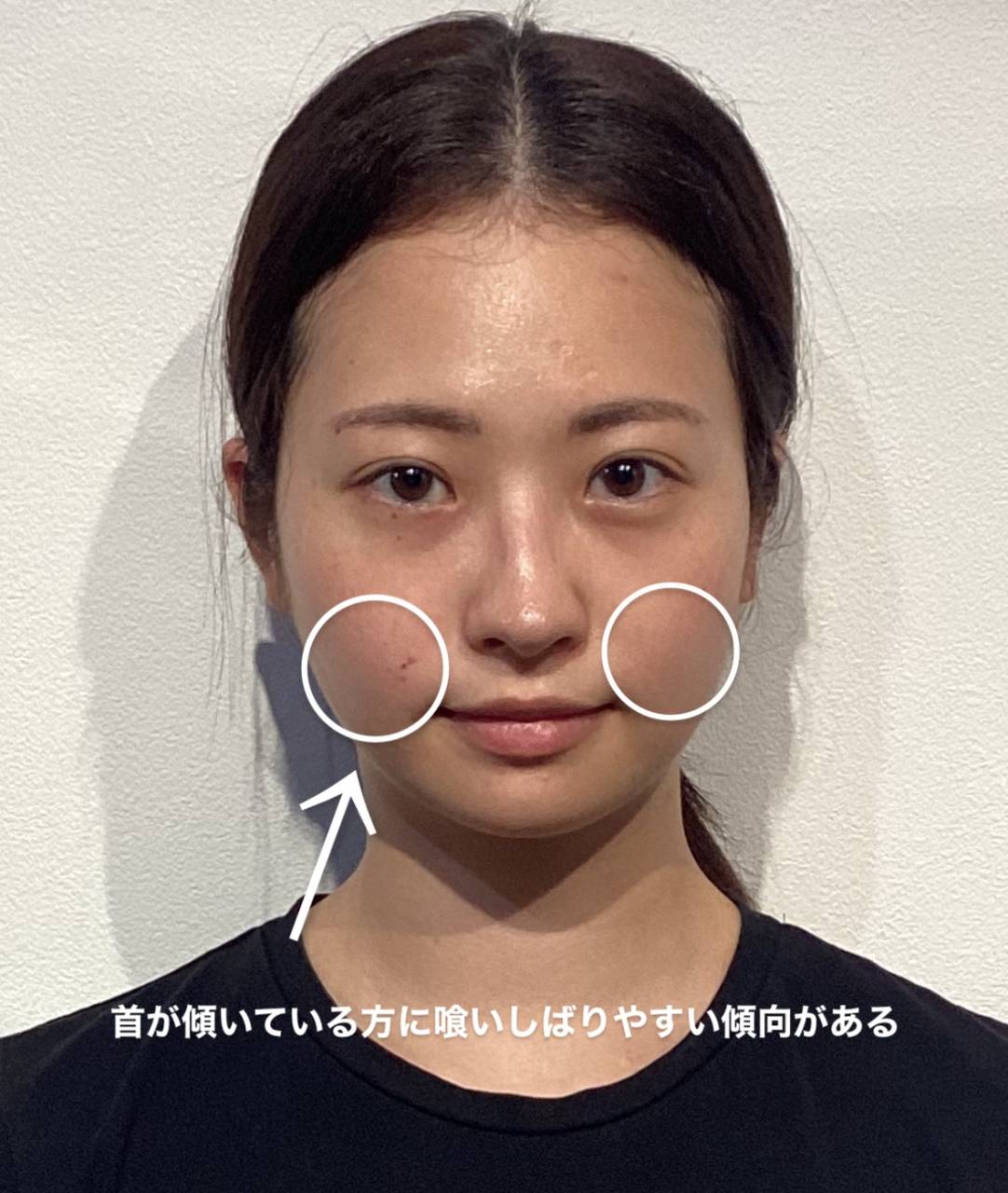 顎が斜めに生えている？顔の歪みが目立たなくなった方法大阪漢方薬対応鍼灸院