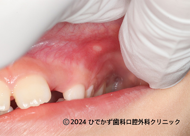 口内炎を写真で解説診察室でよくみる大人の病気 - みやけ内科・循環器科