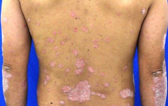 11,200点を超える皮疹のストックフォト、写真、そしてロイヤリティフリーの画像 - iStock