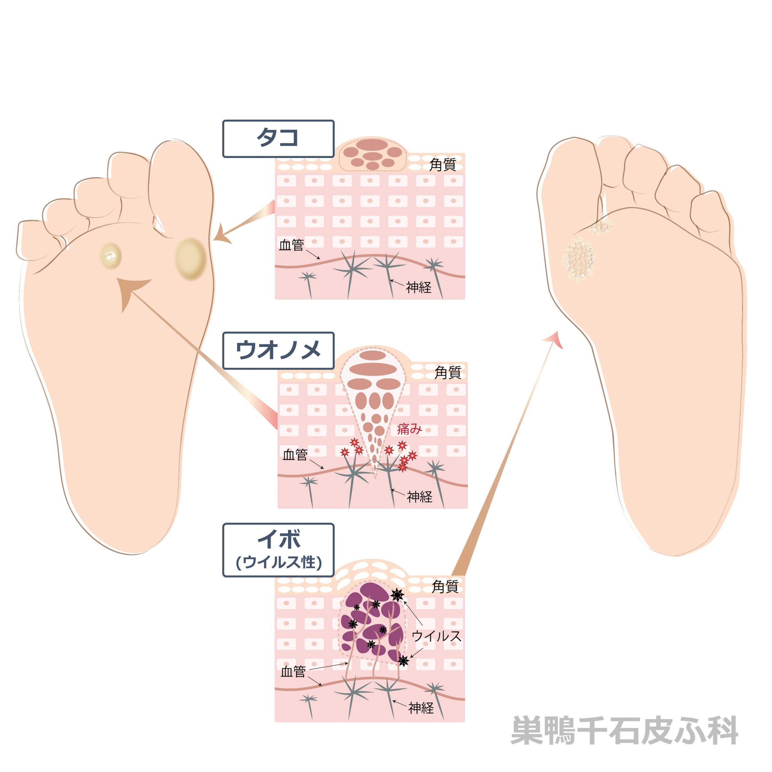 ウイルス性イボ治療東京銀座スキンケアクリニック