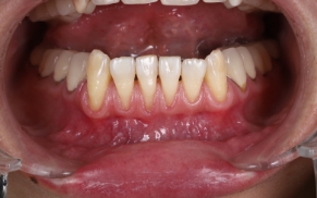 株式会社 ＹＤＭデンタル製品 - ピンセット マイクロアドソン