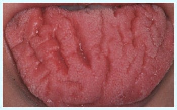 溝状舌 Fissured Tongue の原因と治療法