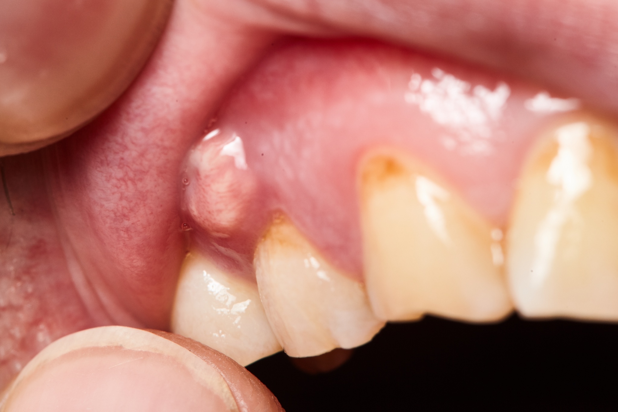 中度 奥歯の歯ぐきの変化 - 治療実績集歯周病治療大阪の歯科クリニック MDENTAL STUDIO