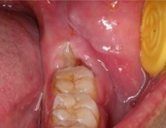 押すと痛い歯茎の腫れはどう治す？アップル歯科伊丹駅前