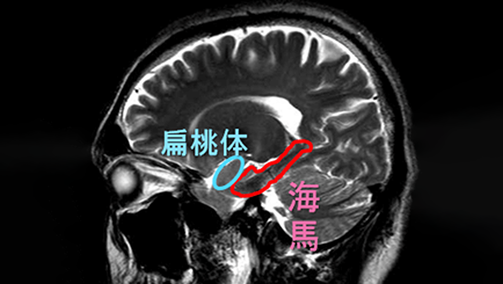 海馬のMRI脳画像診断脳の学校
