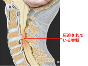 首の前部の痛み・首が締め付けられる感じについて公式 磐田市の整体ならカイロプラクティックベリー20年以上の実績と信頼