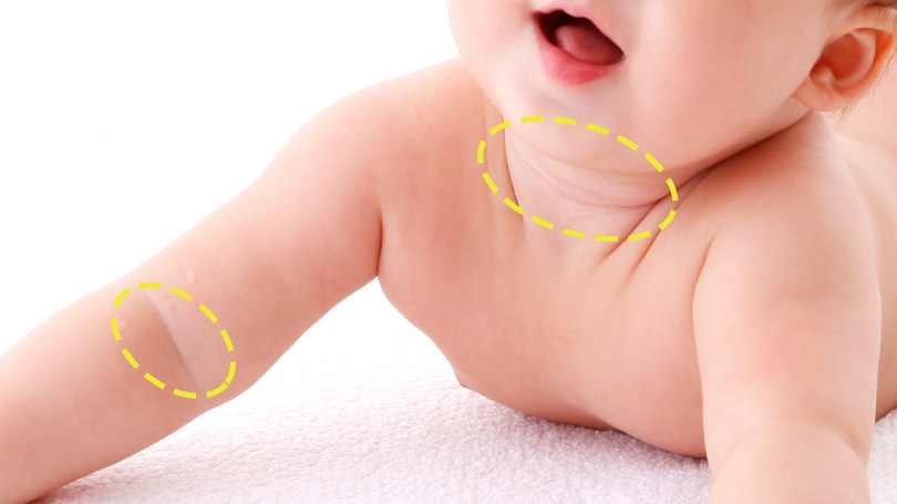 赤ちゃんの皮膚の病気 乳児湿疹・乳児脂漏性湿疹の症状とケア 医師監修 たまひよ