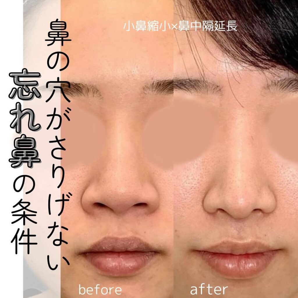 福岡院の鼻尖形成 団子鼻整形eクリニック福岡院 公式 美容整形・美容外科