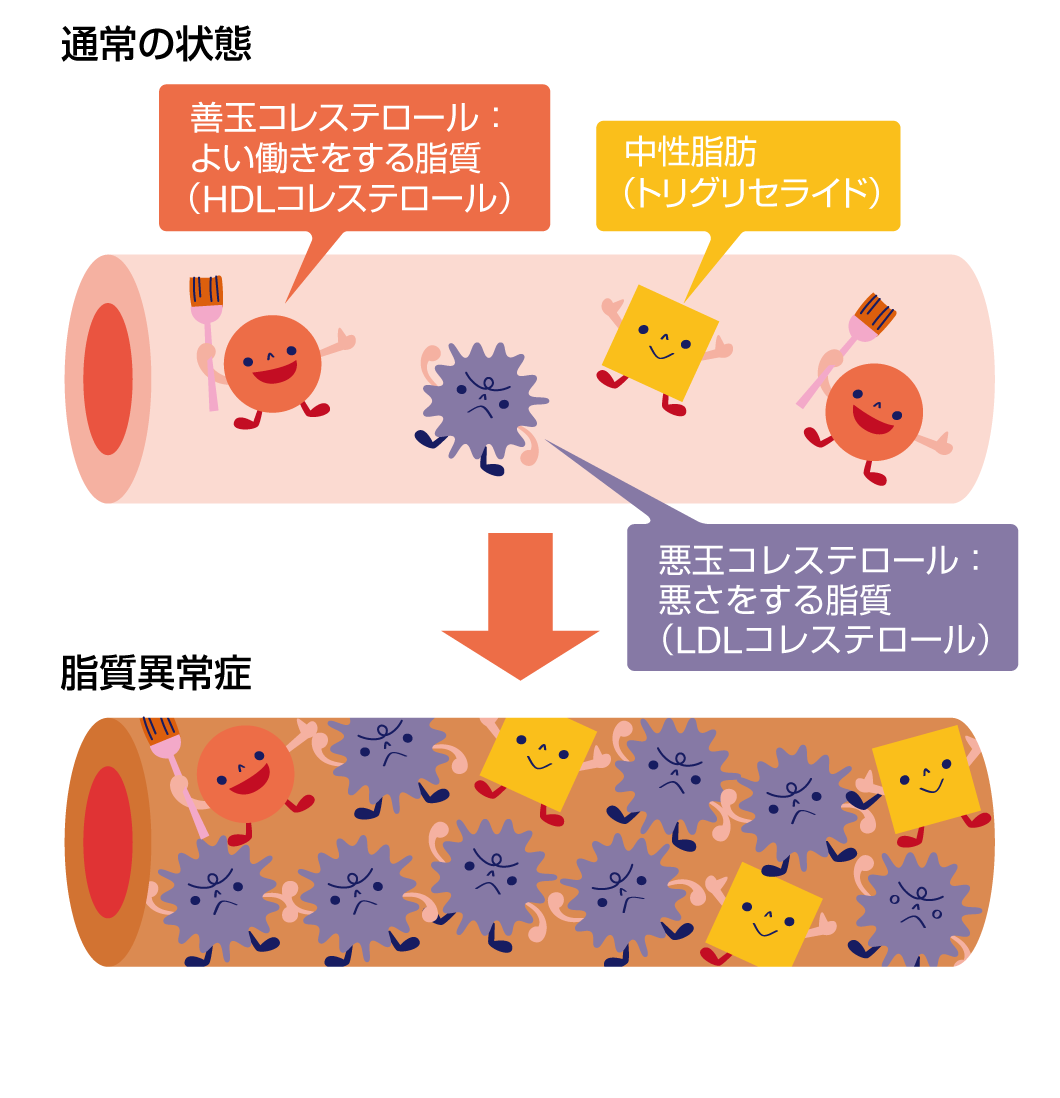 脂質異常症についてやまかわ薬局