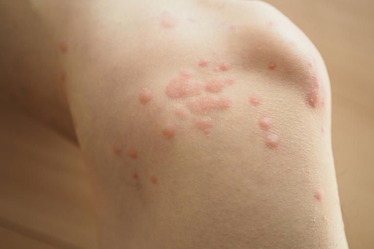 お子様の皮膚疾患についてきむら内科小児科クリニック名古屋市緑区