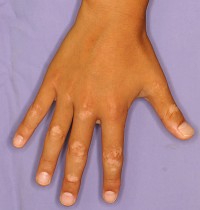 皮膚のトラブル １１ 子どもの白斑 紫外線に弱く、日焼けに注意ヨミドクター 読売新聞