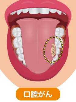 口内炎かどうか気になっている患者様が増えています岐阜県関市のえんどう歯科・矯正歯科クリニック。充実の最新設備
