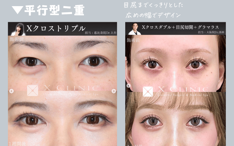 平行二重と末広二重はどっちがいい？目元の魅力をアップする治療法について解説Shinagawa Beauty Navi