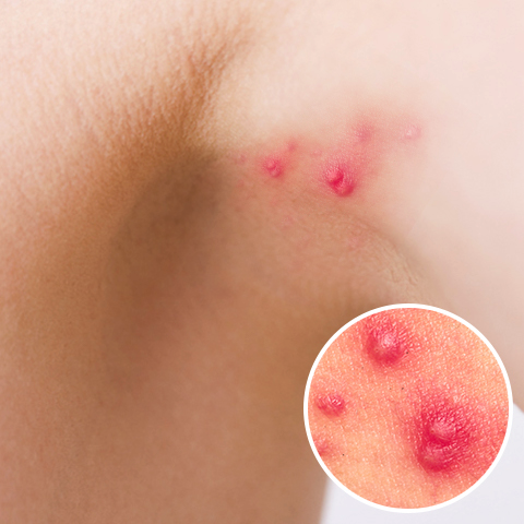 脇のブツブツはどうしてできる？原因と脇を脱毛するメリットを紹介mismos ミスモス