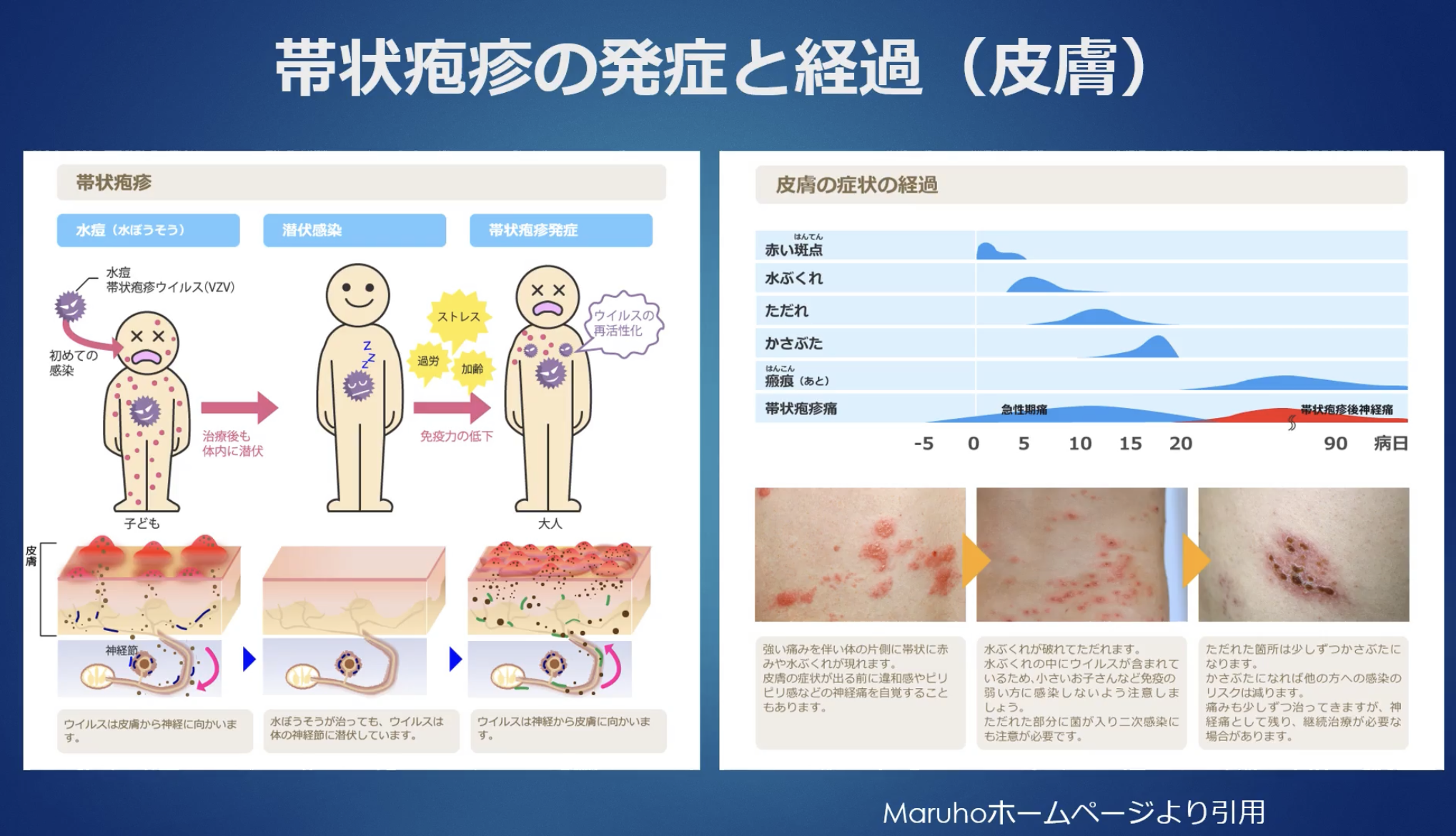 帯状疱疹ウイルス感染症③看護roo! カンゴルー