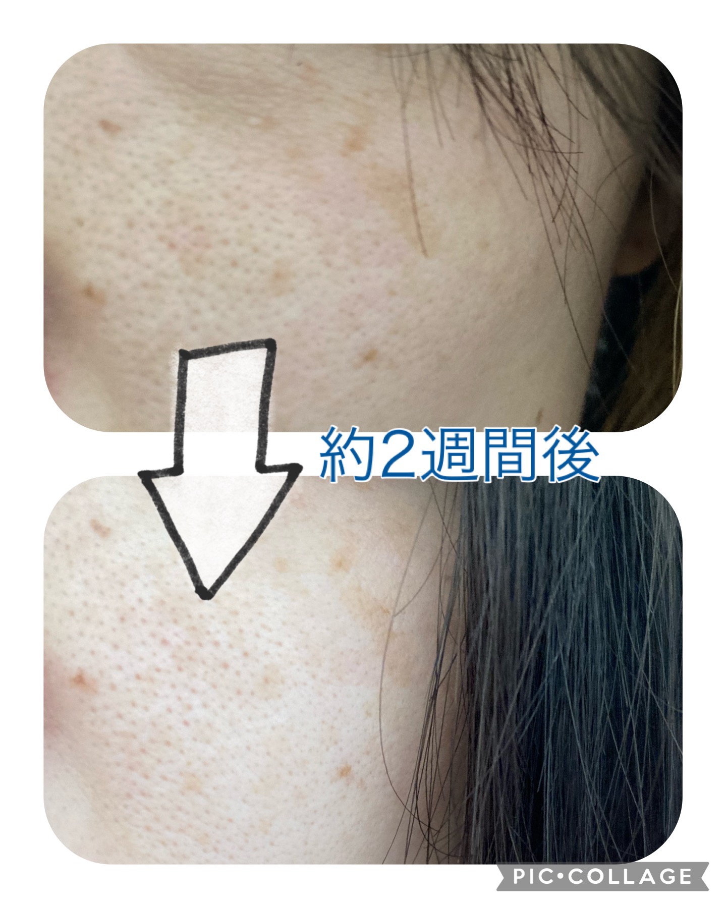 タカミスキンピールで肌ケアの新常識