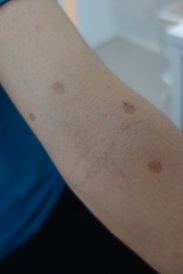 柔道やレスリング選手を中心に蔓延する皮膚真菌症についてKOHKIN LABの新たな取組み株式会社HONUのプレスリリース