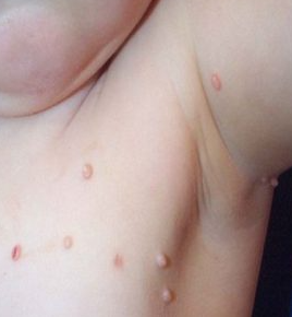 みずいぼとは？ - つつみこどもクリニック