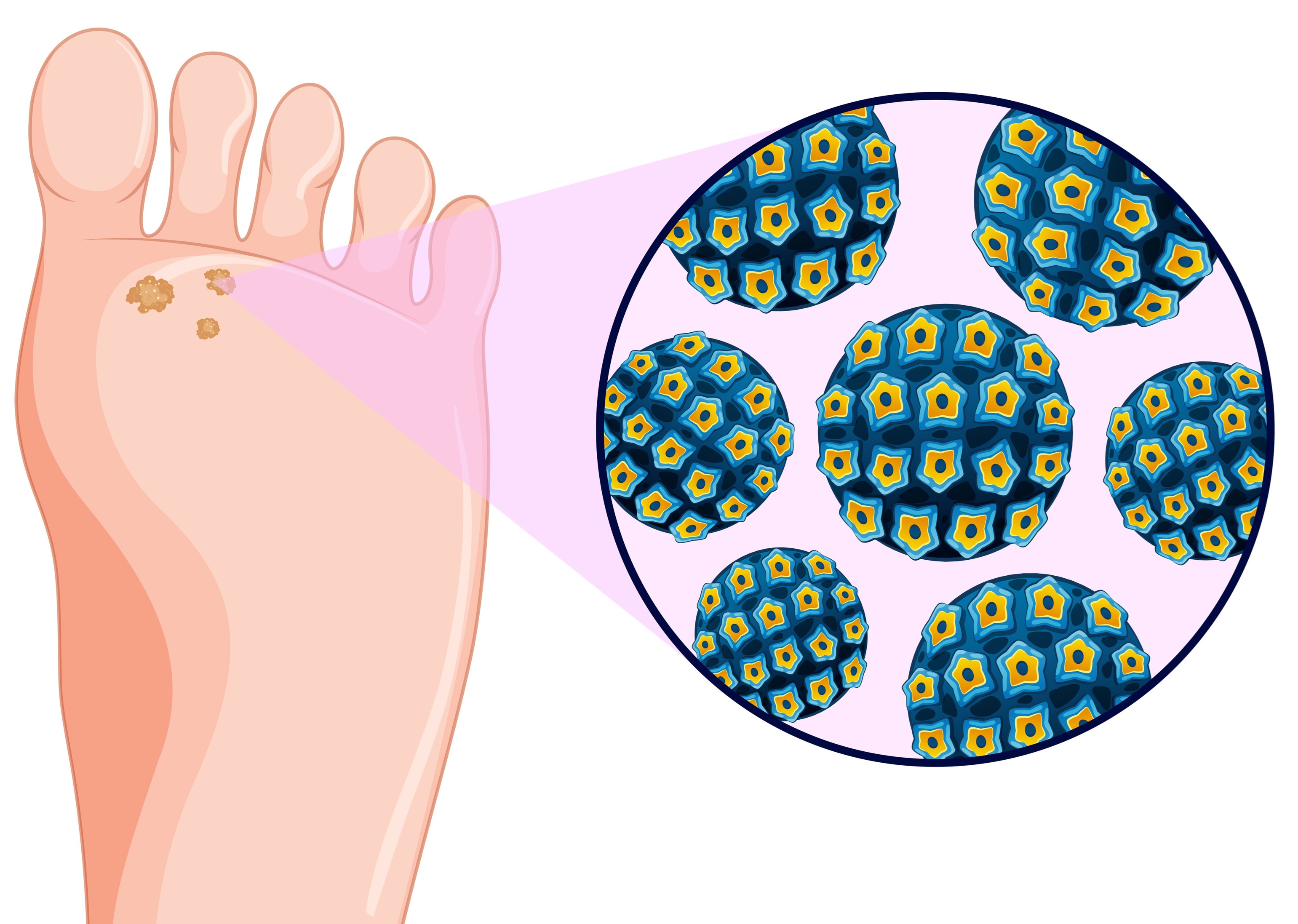 いぼ 尋常性疣贅 吹田市の皮膚科もりはら皮ふ科クリニック