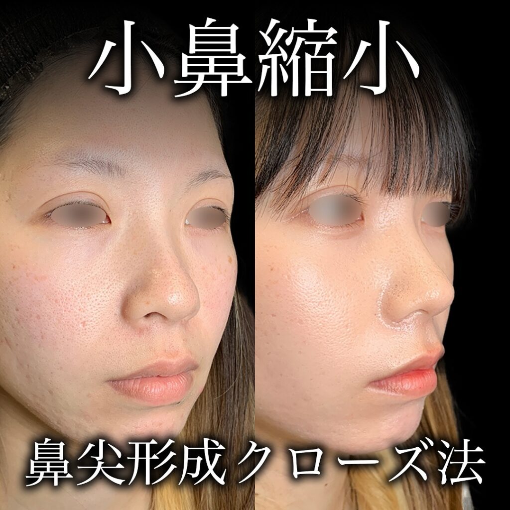 美人整形垢さんの公表されている整形レシピまとめてみた。 みんな顔フルだね。 🏥全国の技術専門医のご紹介やお得なクーポン特典&PR情報はプロフィールURLのメールフォームからお問い合わせください📩📞090-8435-3332 全切開鼻孔縁挙